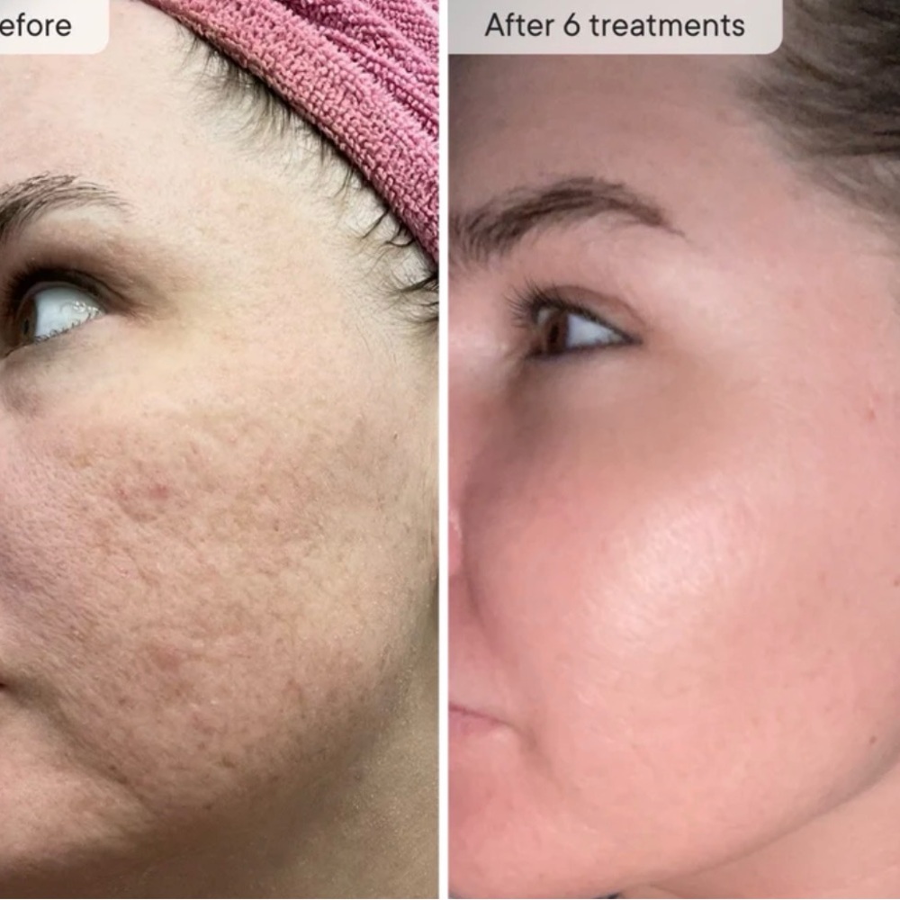 Micro-Infusion Facial System - Qure 2 month supply. Dark spot serum. See descr - Picture 4 of 4
